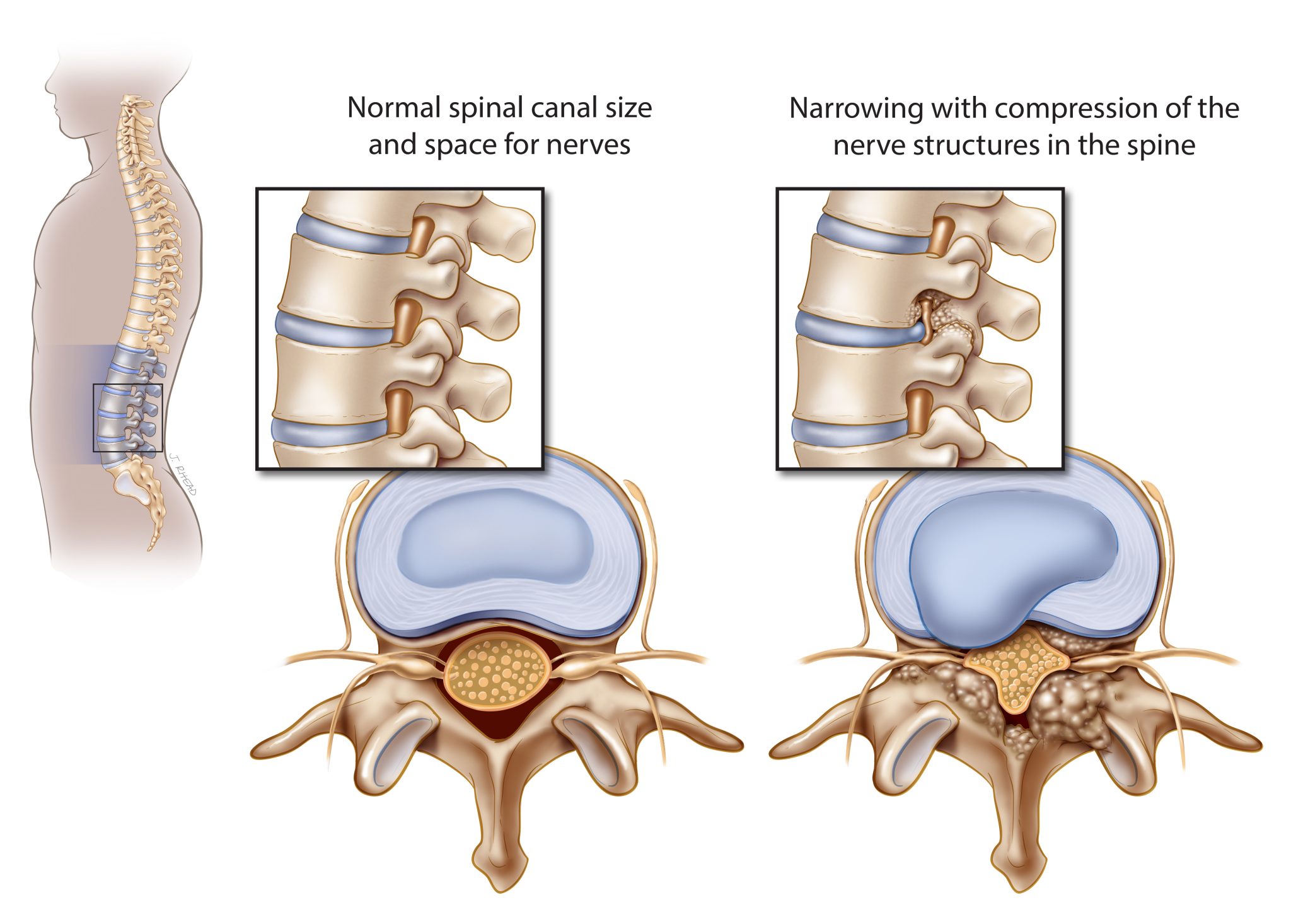 Lumbar Conditions And Procedures Oregon Spine Care