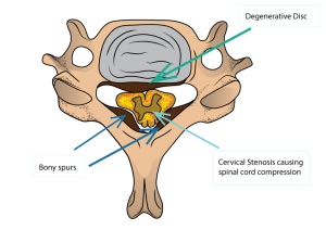 Cervical Conditions - Oregon Spine Care